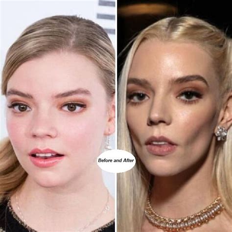 anya taylor-joy before and after surgery|anya taylor joy lip filler.